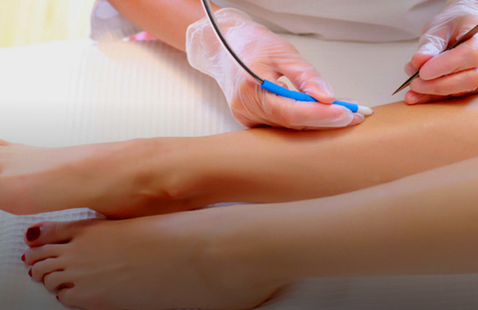 Процедура электроэпиляции на женской ноге