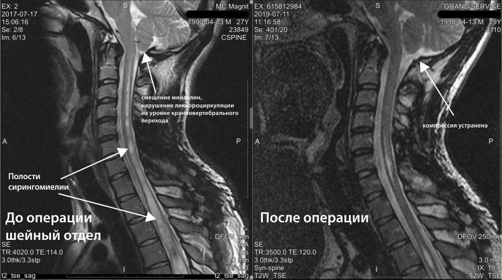 Аномалия арнольда киари операция. Аномалия Арнольда Киари. Аномалия Киари спондилограмма. Что такое Арнольда Киари 2 степени.