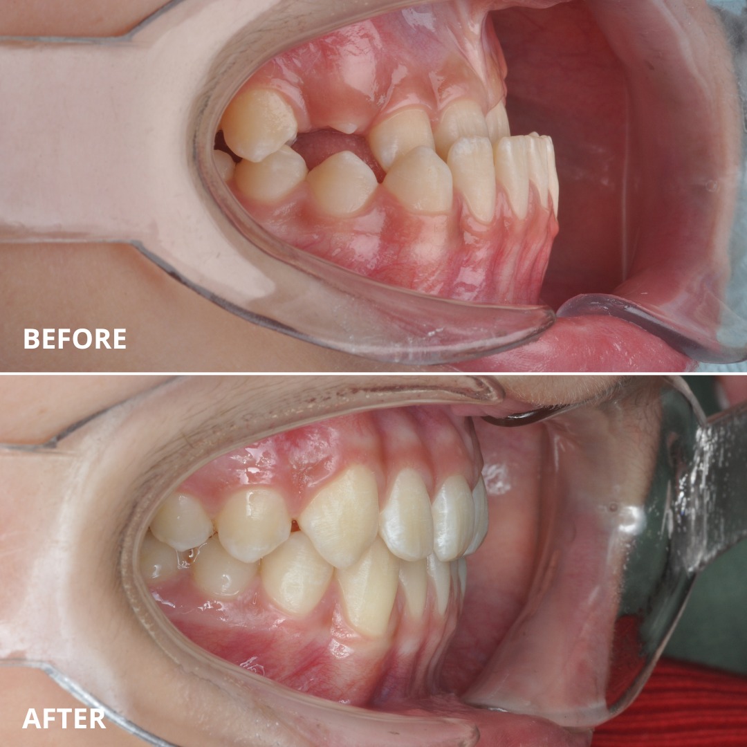 Stage view approaching correction of the mesial bite relationship — photo 6 of 7