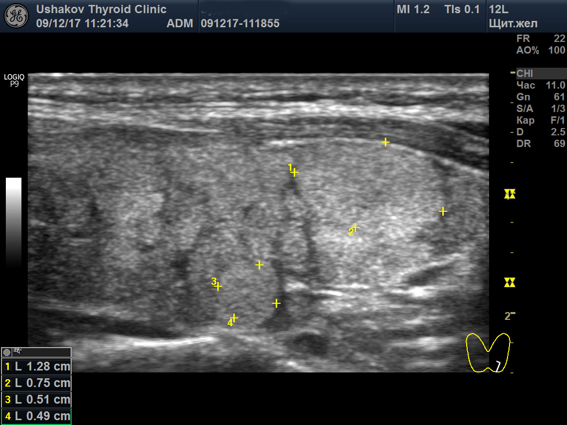 Загрудинный узел щитовидной железы. Диффузно узловое образование щитовидной железы. Солидно-кистозное образование щитовидной железы на узи. Диффузно узловое образование щитовидной железы. Узи щитовидной железы диффузные изменения по узи.