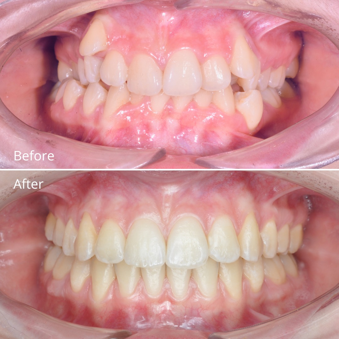Stage photo showing gentle, gradual expansion during non-extraction treatment — photo 2 of 4