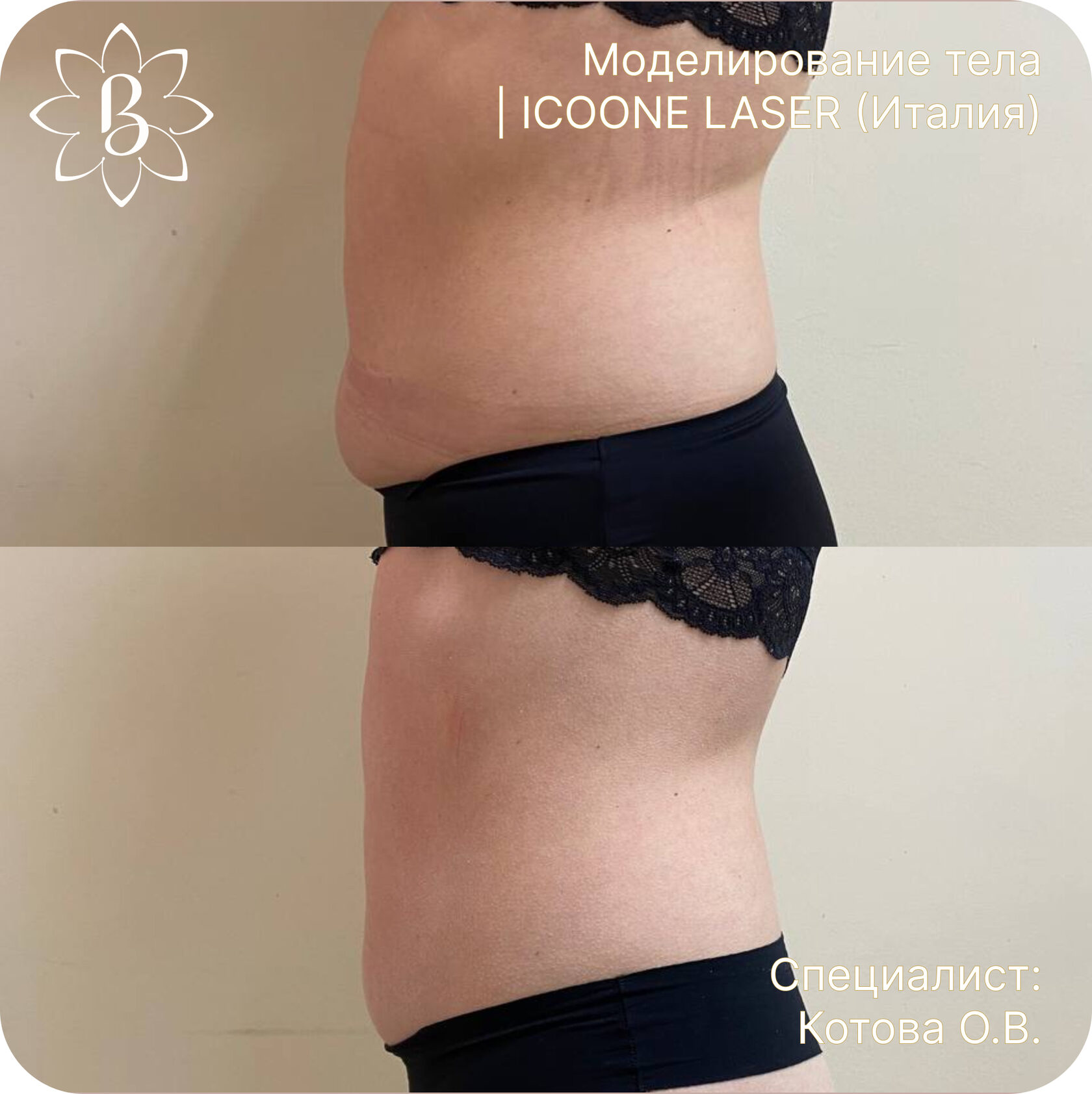 Диодная лазерная эпиляция СПб