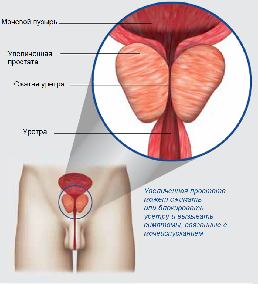 Эмболизация артерий предстательной железы