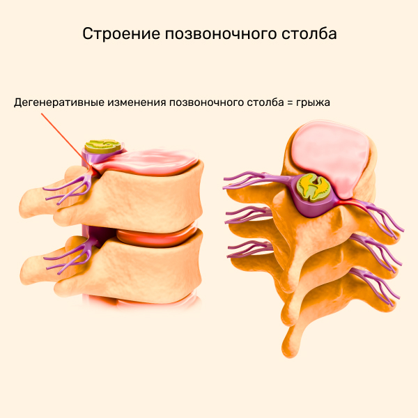 Протрузия - причины, симптомы, можно ли вылечить без операции