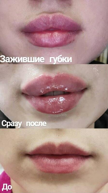 Увеличение и коррекция губ, примеры работ до и после