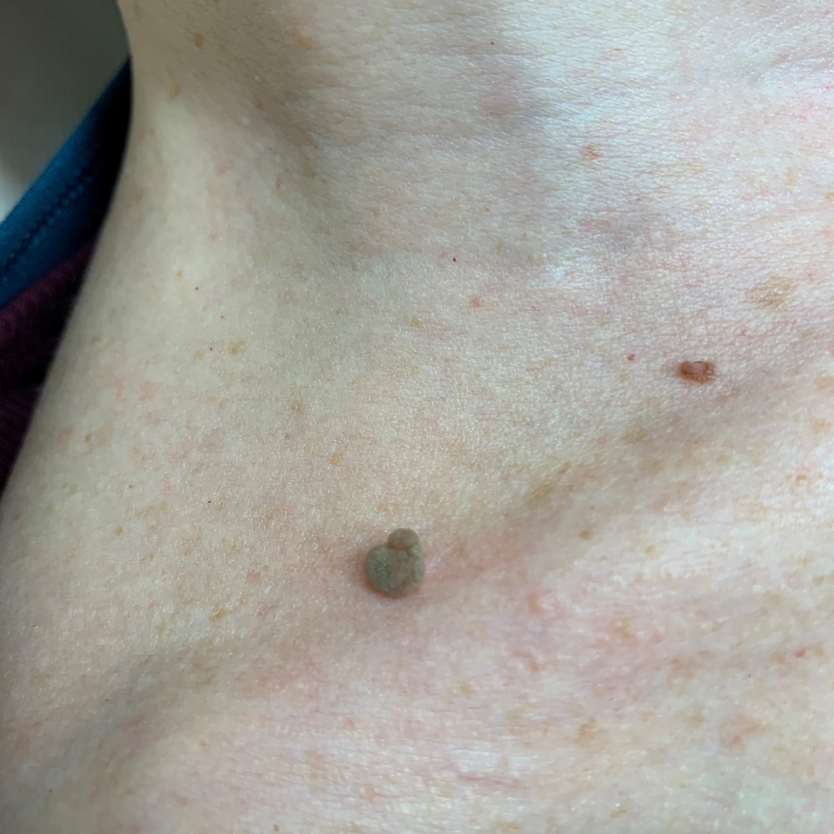 Risultati pre post trattamento laser Co2