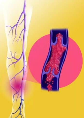 Тромбоз глубоких вен нижних конечностей: симптомы и лечение | Альтермед