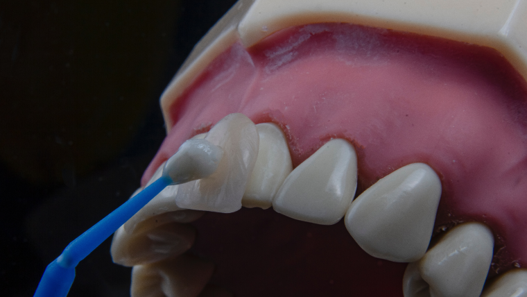 Виниры — виды, этапы установки, цены в Дербенте. Стоматология DK