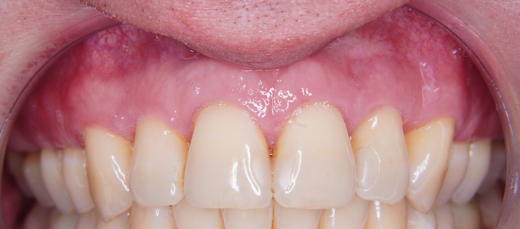 Клиническая фотография зубов из материалов терапевтического направления Dental Studio
