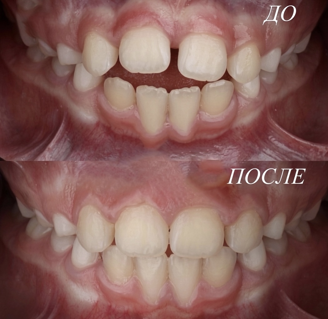 Кейс до и после: перекрёстный прикус