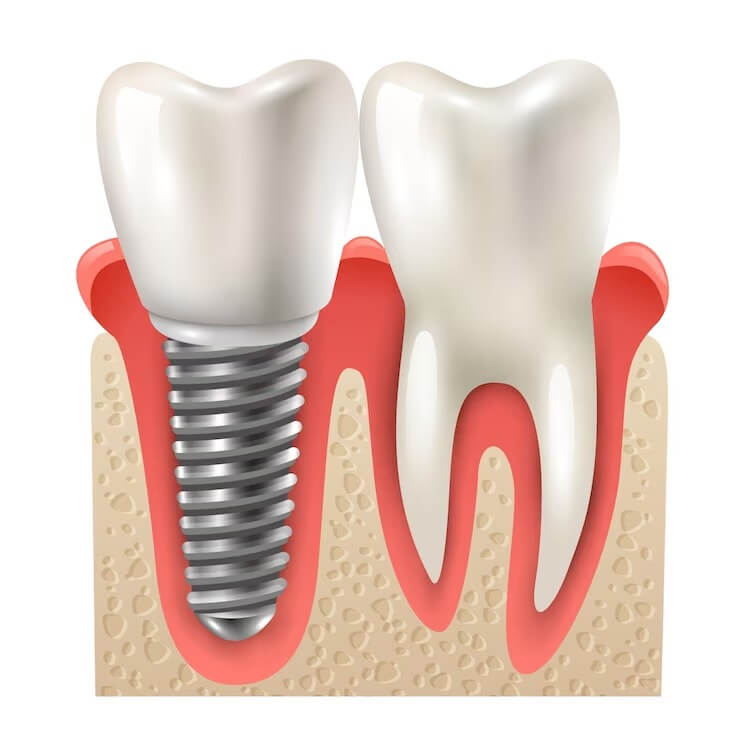 Что делать, если сломался зуб или откололся его кусочек? | Виды сколов и методы восстановления