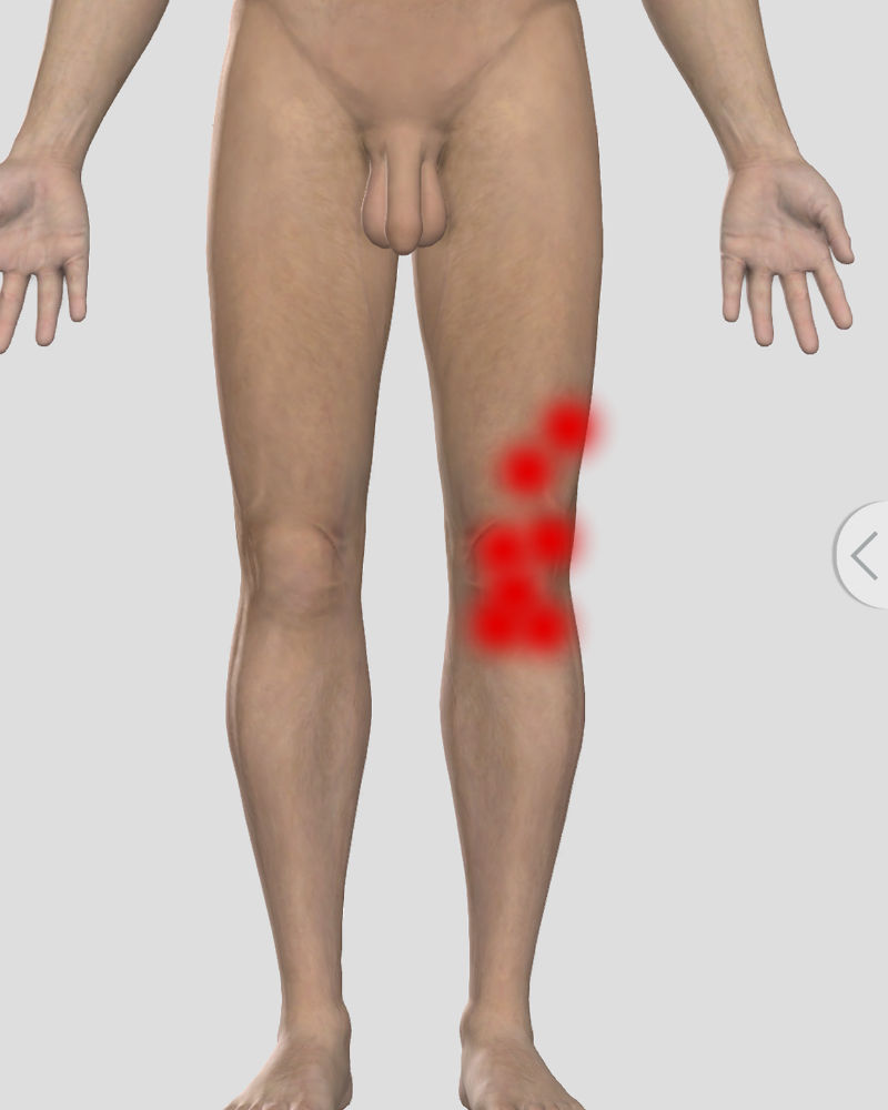 Артроз колленного сустава: симптомы, методы лечения