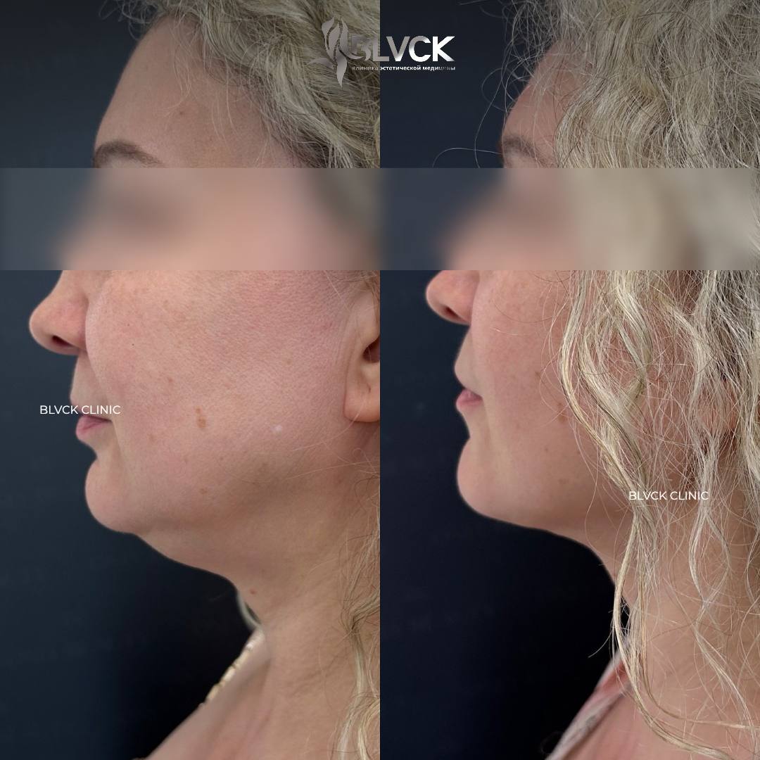 результат устранения второго подбородка в Blvck Clinic процедурой Smas-лифтинга