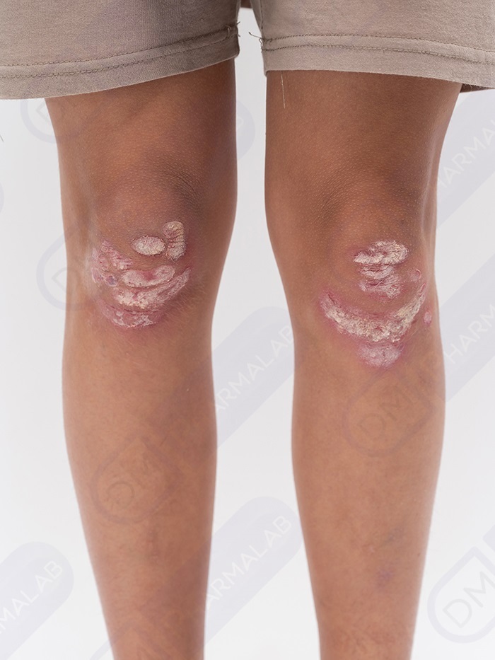 Крема и препараты от кожных заболеваний - ДМ Фармалаб РУС