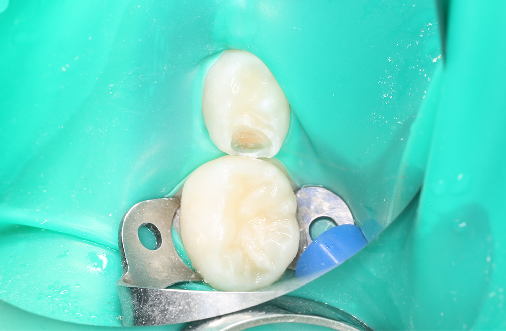 Реставрация молочного зуба композитным материалом после лечения межзубного кариеса у ребёнка