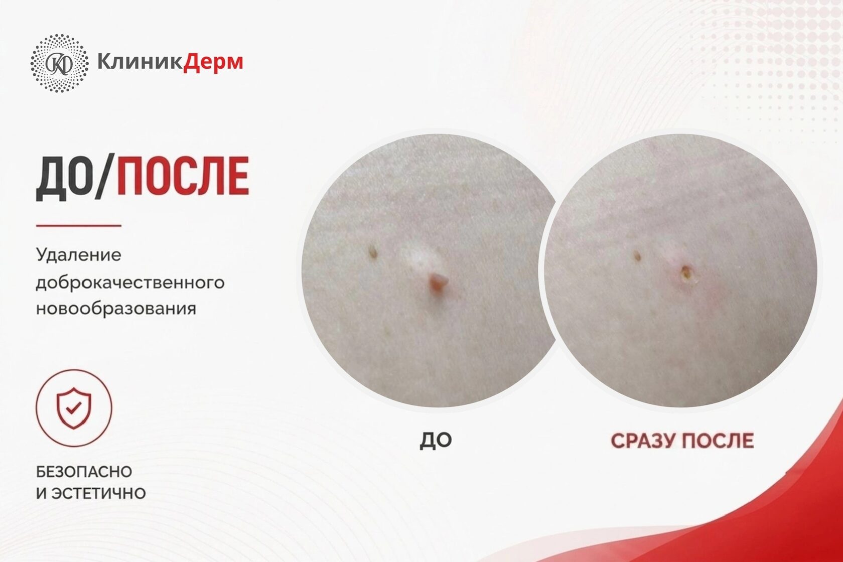 После Удаления Папиллом Можно Заниматься Сексом