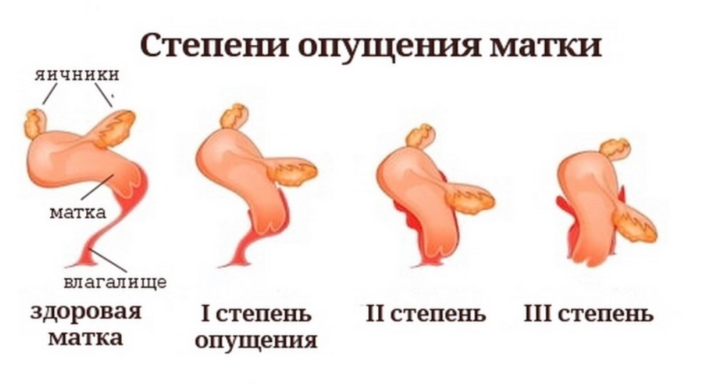 Опушенный матка. Выпадение матки у женщин. Степени опущения матки. Выпадение матки пессарий. Кольцо для шейки матки при беременности.