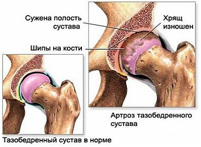 консультация травматолога, тазобедренный сустав, коксартроз