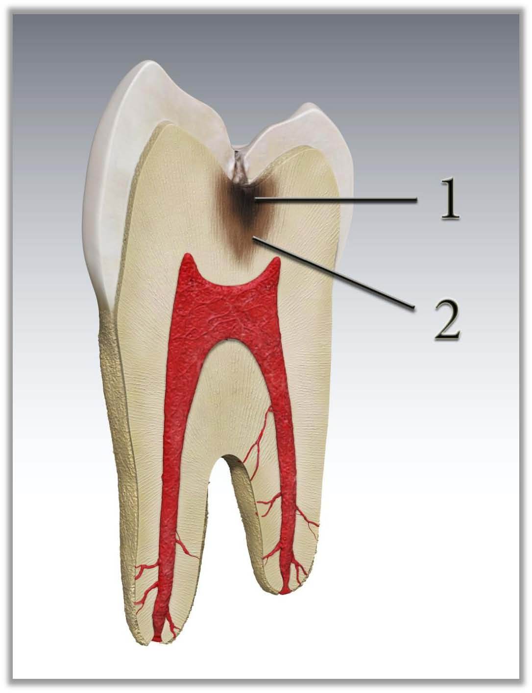 гиперминерализированный дентин. пигментированный дентин. инфицированный дентин. инфицированный дентин. строение апекса зуба.