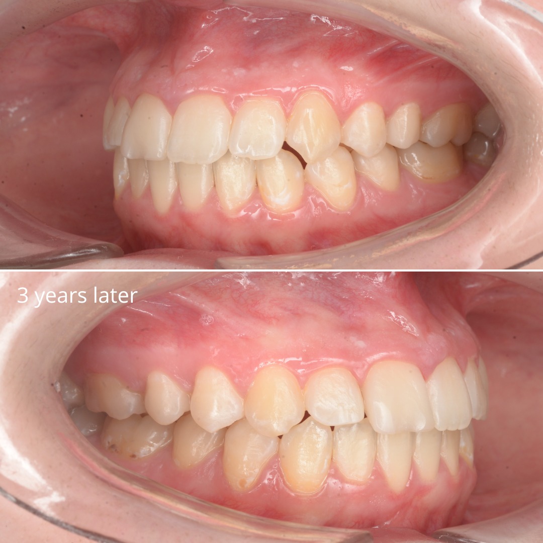Stage shortly before debonding, showing a wide, even arch — photo 6 of 7