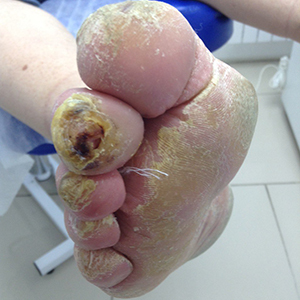 Педикюр при сахарном диабете в Курске