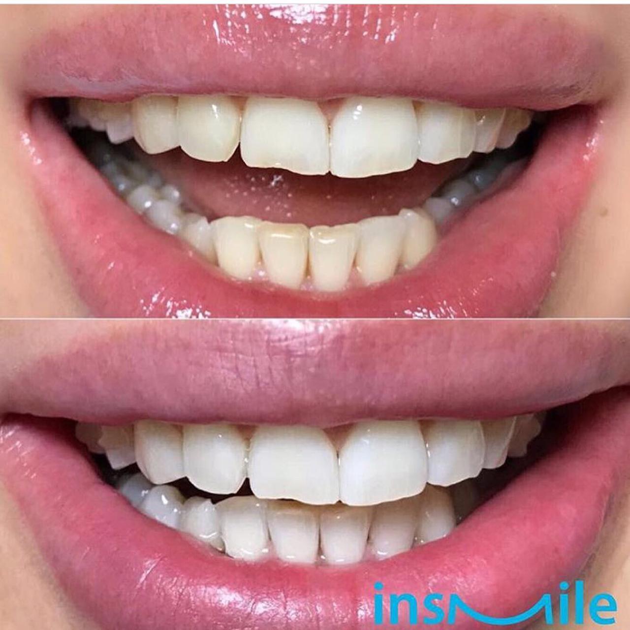 INSMILE отбеливание