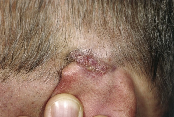 10.18203/issn.2454-5929.ijohns20200639