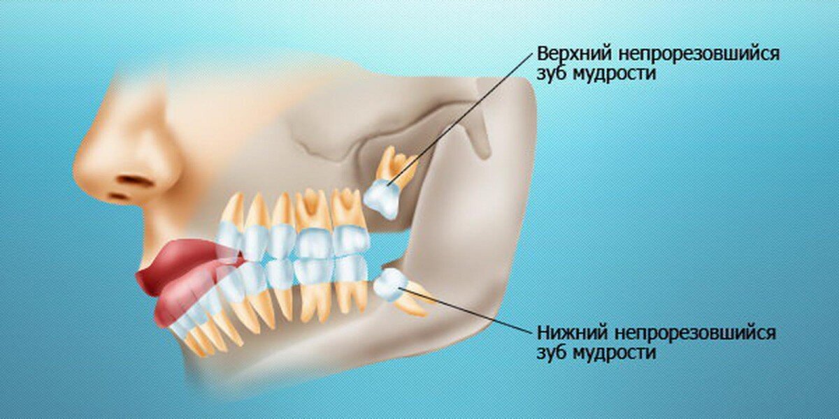 Зуб мудрости