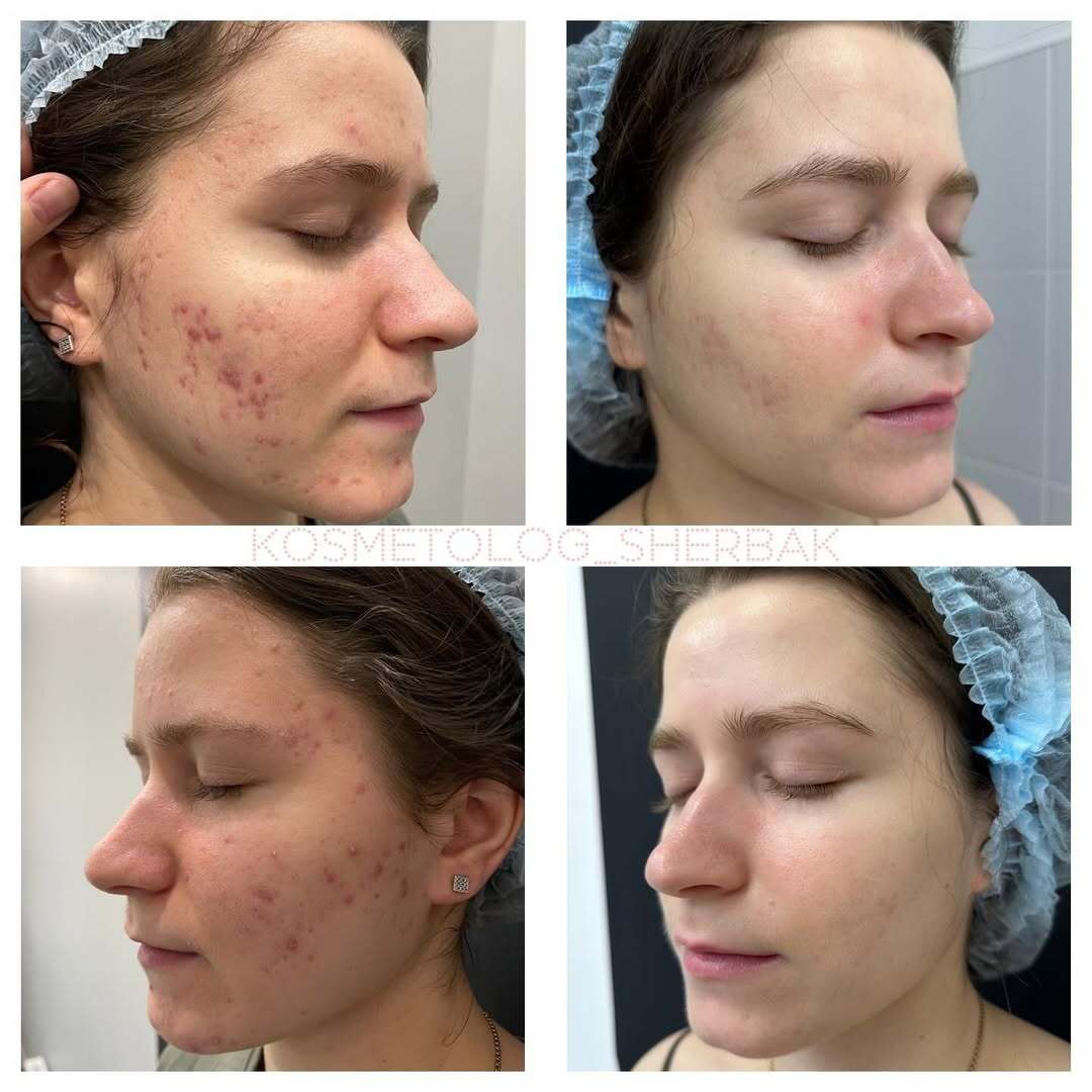 Лечение акне у женщины в клинике PradusCOSMO, СПб. До и после процедуры
