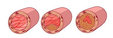 кальцинирование сосудов из--и избытка кальция в воде
