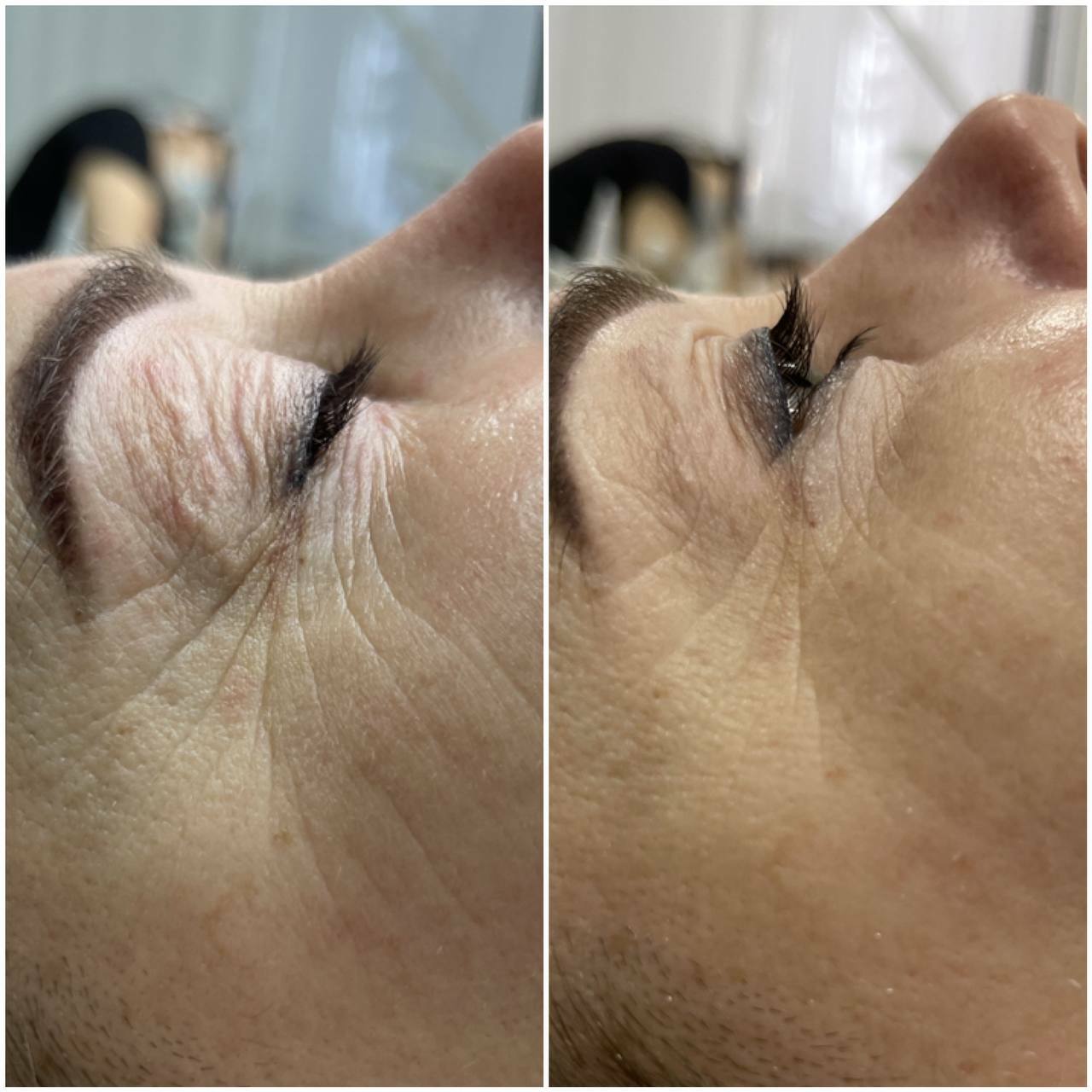 ДО/ПОСЛЕ ЭСТЕТИЧЕСКИХ ПРОЦЕДУР