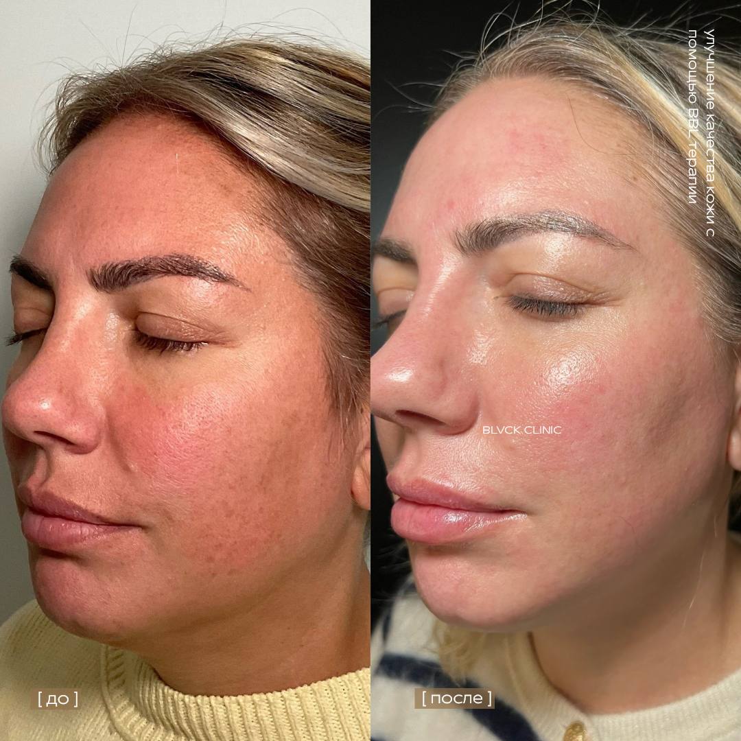 BBL на SCITON от пигментных пятен в Blvck Clinic