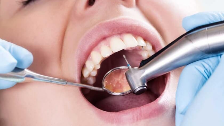 Лечение кариеса — цены в Дербенте. Стоматология DK