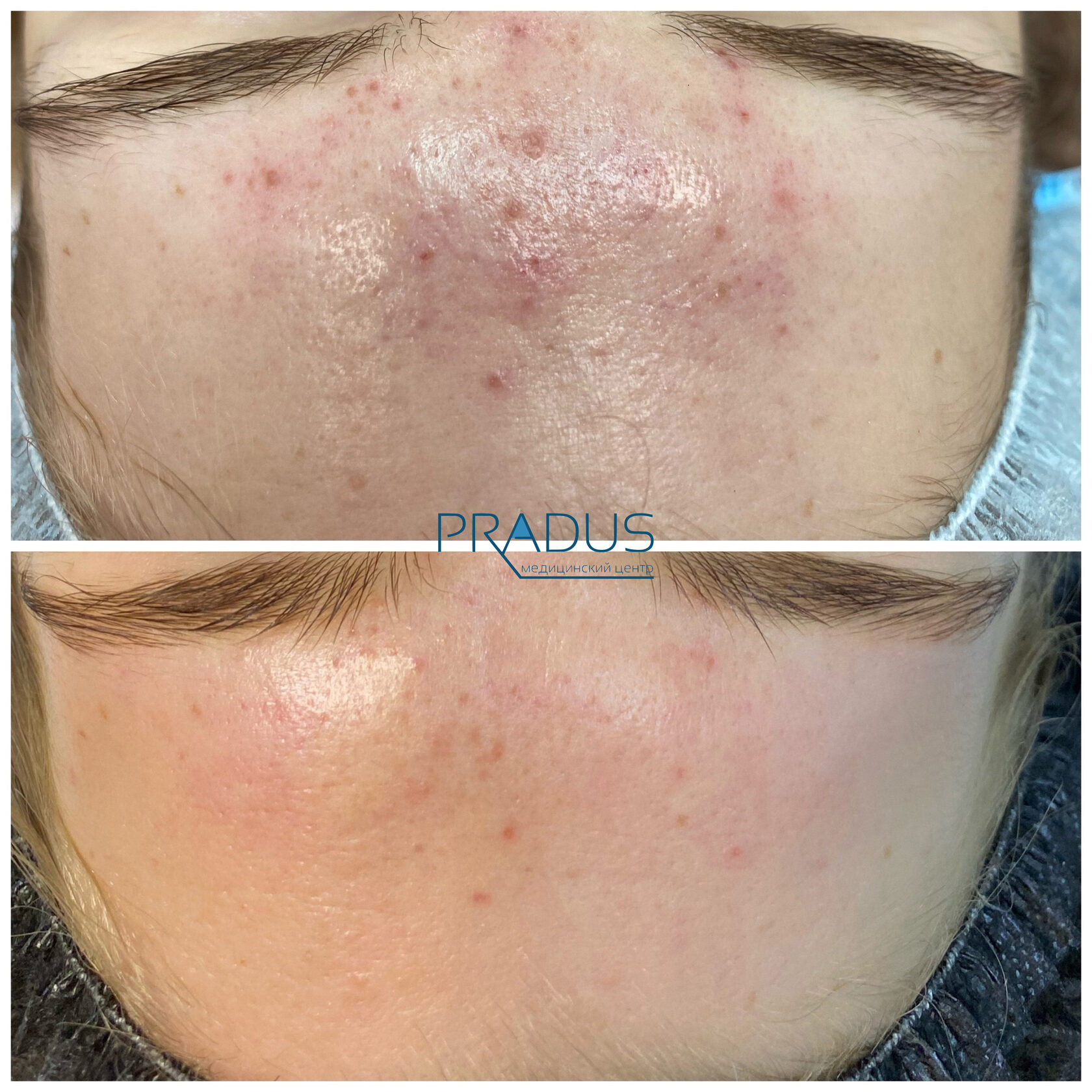 Лечение акне у женщины в клинике PradusCOSMO, СПб. До и после процедуры
