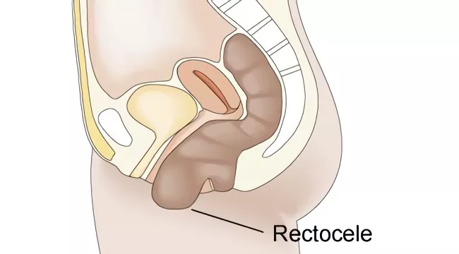 Операция на ректоцеле: как проходит и реабилитация