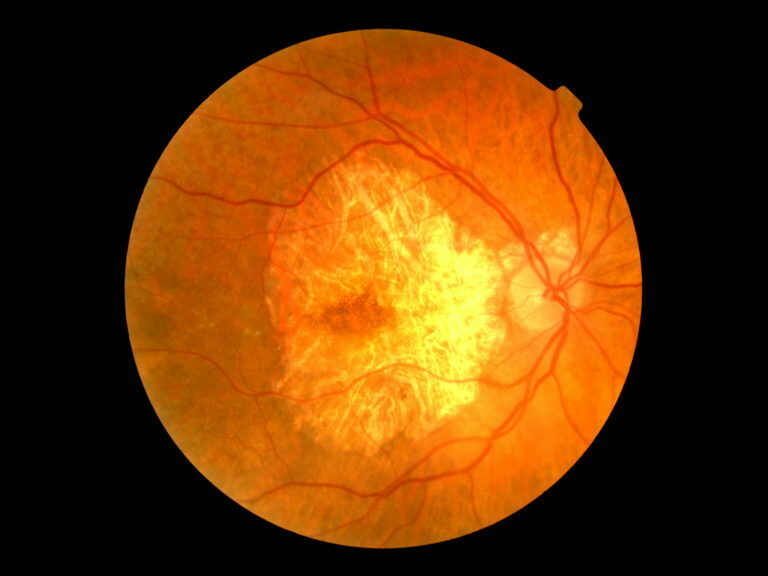 неизлечимое заболевание глаз, возрастная дегенерация желтого пятна
