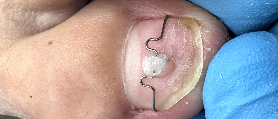 титановая нить, установка титановой нити, скоба фрейзера, установка скобы фрейзера, скоба 3ТО, установка скобы 3ТО, скоба Unibrase, установка скобыunibrase, пластины, крючковые системы, клеевые системы 