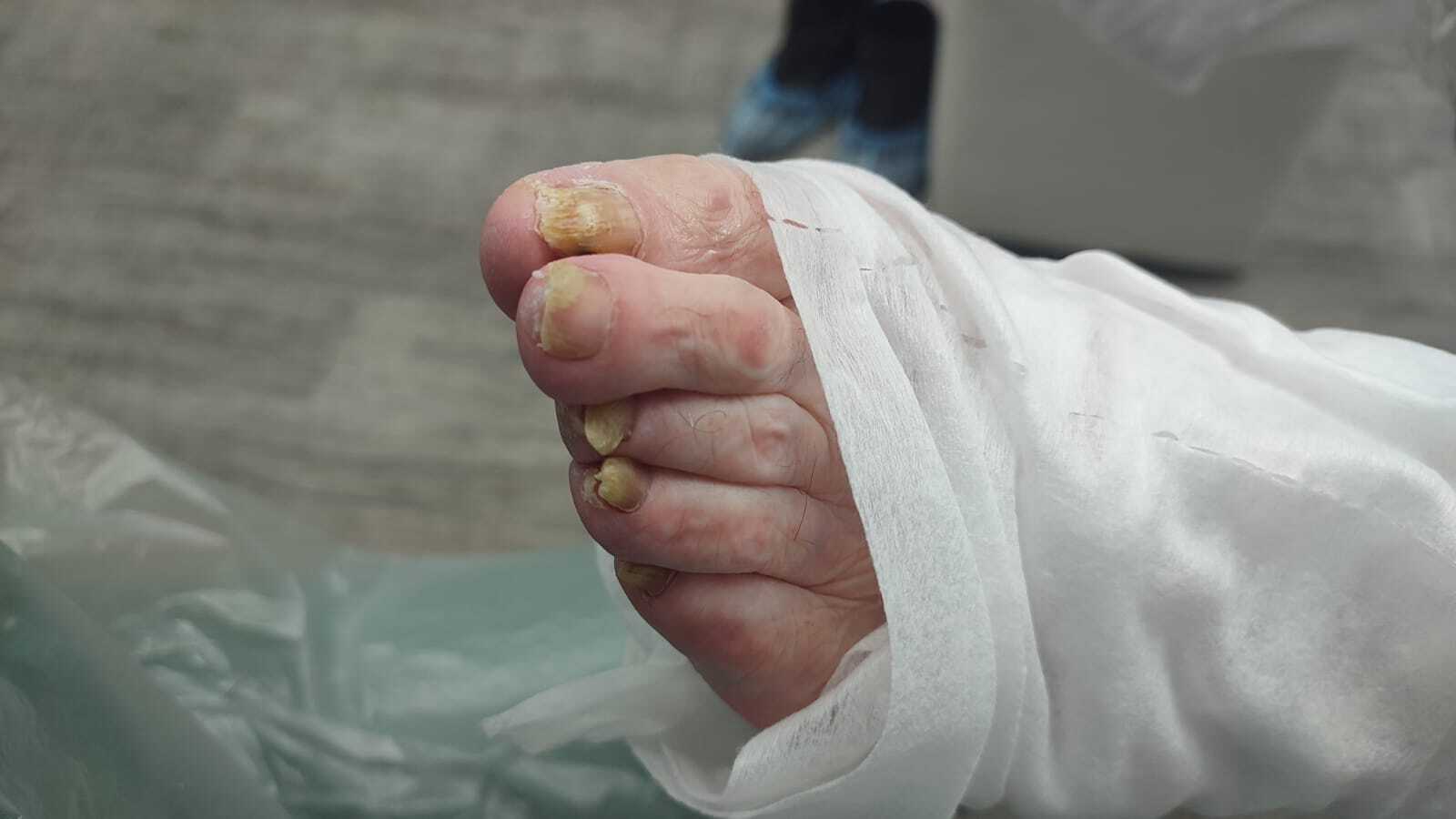 вросший ноготь на ноге, вросший ноготь, удаление вросшего ногтя, вросший ноготь лечение, вросший ноготь операция, удалить вросший ноготь, вросший ноготь цена