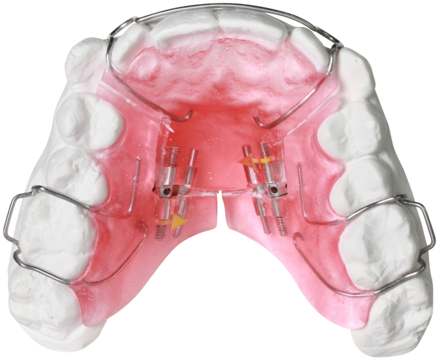 Ортодонтическая пластинка. Ортодонтическая пластинка (с использования винта Бертони). Аппарат Бенефит ортодонтия. Аппарат RPE для расширения верхней челюсти. Пластиночные ортодонтические аппараты.