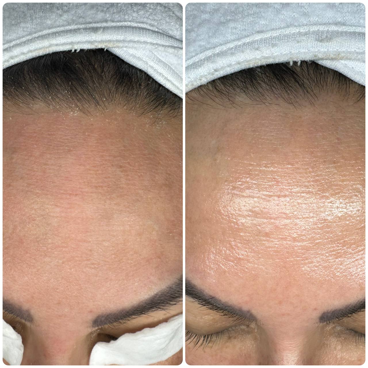 HydroDermabrasion before and after forehead dehydration lines softened Beauty Studio by Hanna Mount Pleasant SC