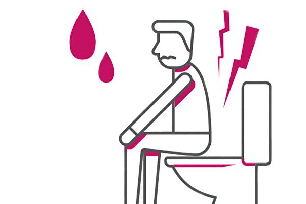 Острый геморрой: причины и лечение [Видео]