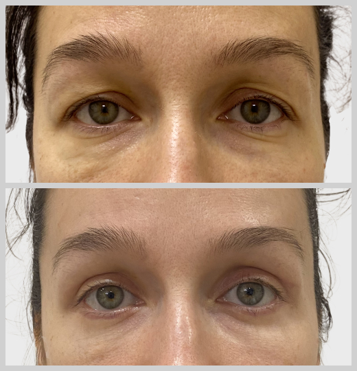 блефаропластика нависшие веки