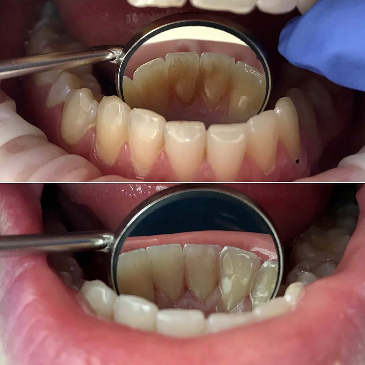 Чистка зубов у стоматолога как делается фото