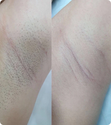 лазерная эпиляция СПб