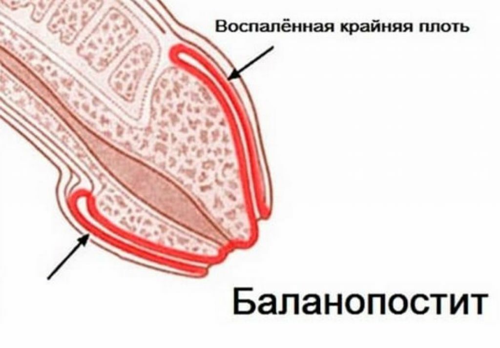 Баланопостит у ребенка картинки