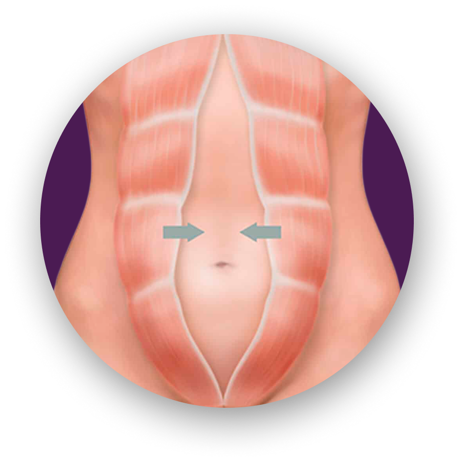 Диастаз мышц брюшного пресса у мужчин