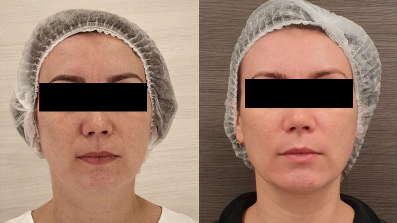 Фото до и после: удаление сосудов лазером в клинике PradusCOSMO, Санкт-Петербург. Безопасно, эффективно и без повреждений кожи