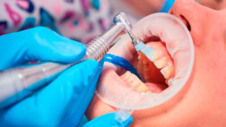 Чистка зубов Air Flow — цены в Дербенте. Стоматология DK