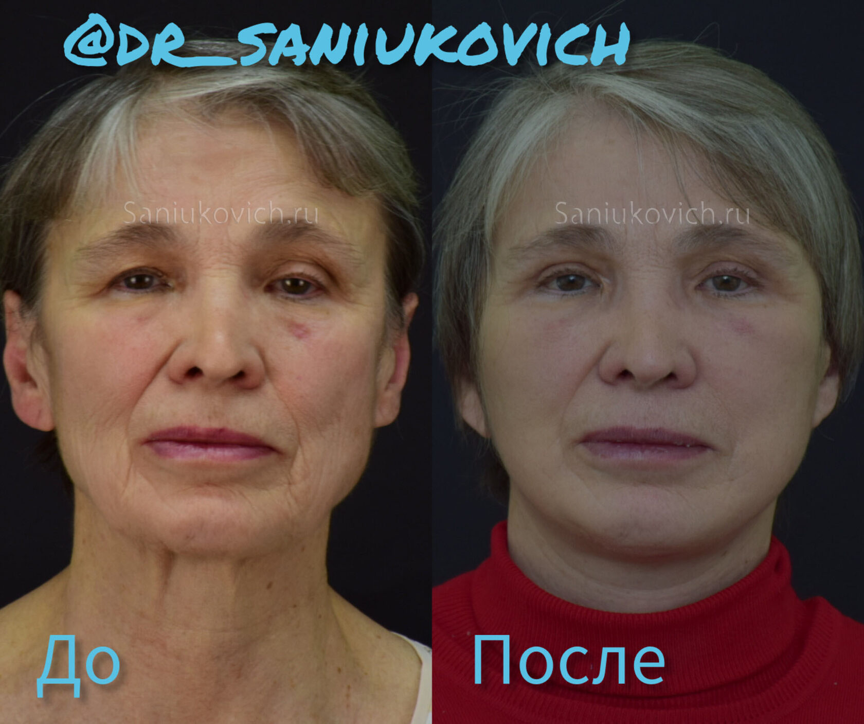 SMAS facial plastic surgery result