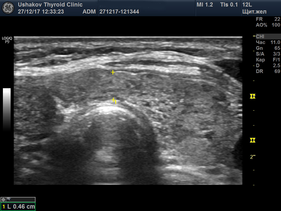 Уз картина диффузных изменений паренхимы щитовидной железы